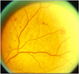 DIABETIC RETINOPATHY – Retina Specialists Victoria